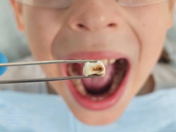 Best Emergency Tooth Extraction  in Manchaca, TX